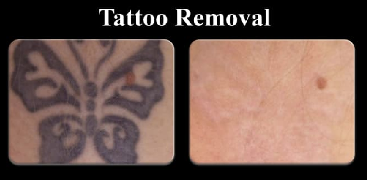 Tatoo Removal