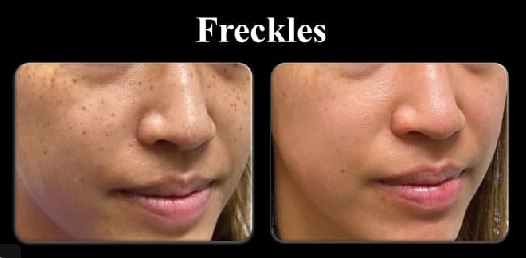 Freckles