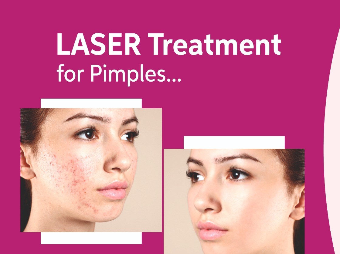 Laser Treatment