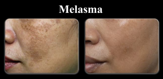 Melasma