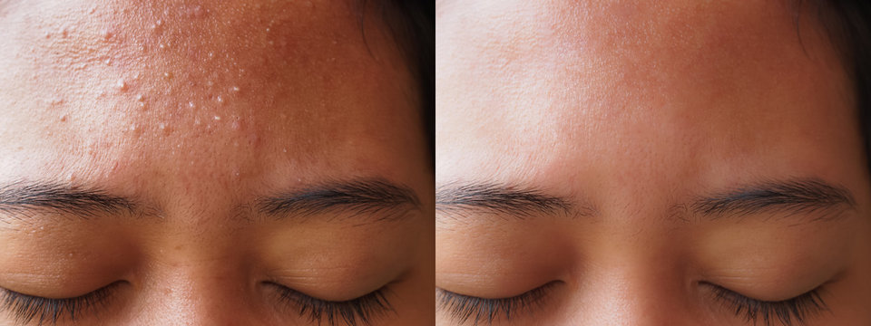 Acne Treatment