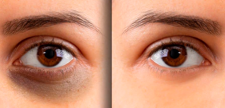 Dark Circles Treatment