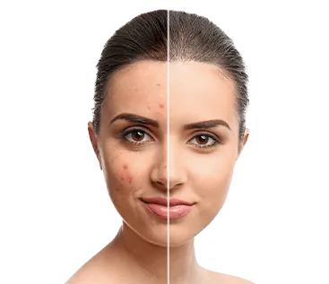 Laser Pimple Treatment