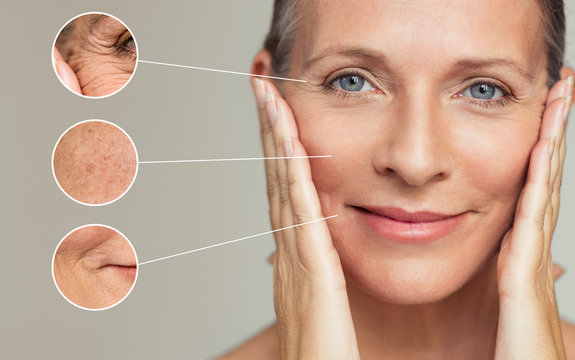 Anti-Wrinkle Treatment